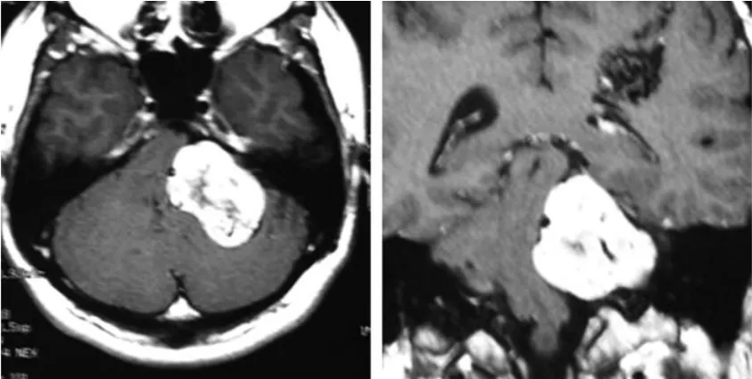 首次就诊时的轴位CT（左）和增强冠状位T1加权MRI（右）显示左侧桥小脑角区肿瘤并脑干受压
