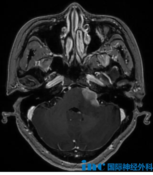 术前MRI