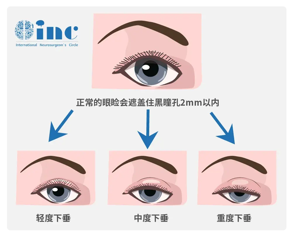上睑下垂