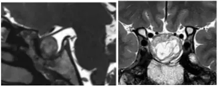 图3:术后一年MRI