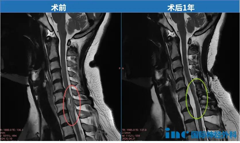 颈7水平脊髓髓内肿瘤术前术后影像对比显示肿瘤获得全切