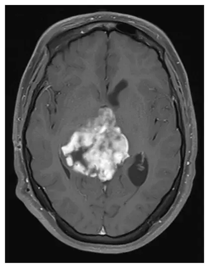 图1 MRI