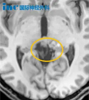 术前MRI