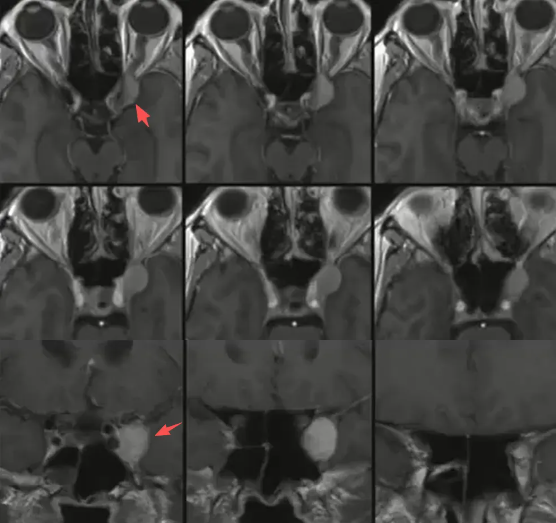 术前MRI