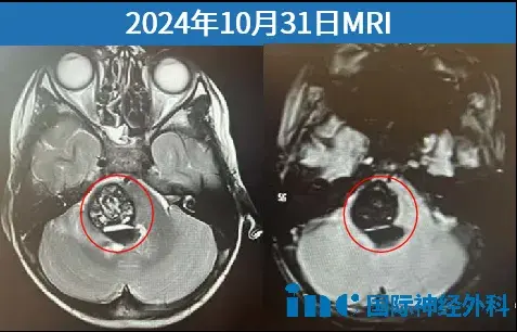 术前MRI