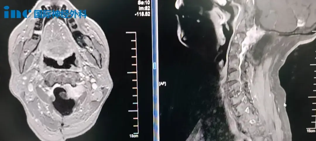 术前MRI