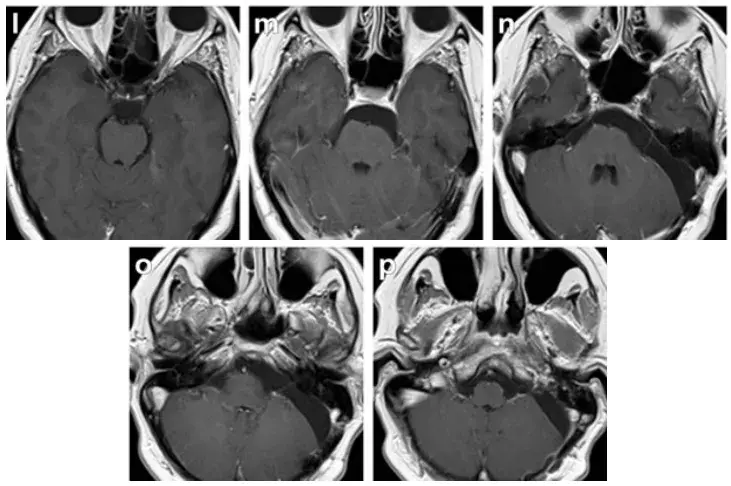 术后MRI