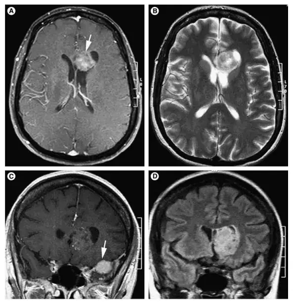 图1：术前MRI