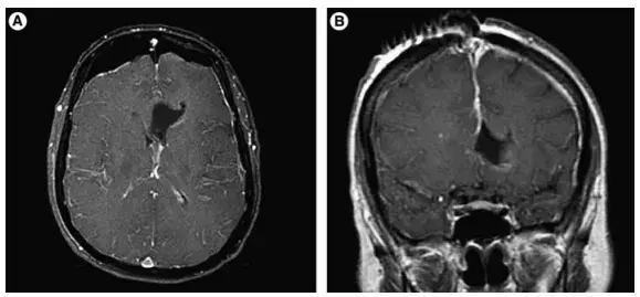图2：术后MRI