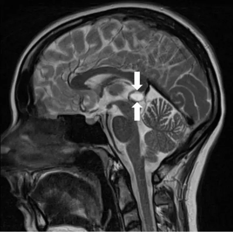 图1：术前MRI