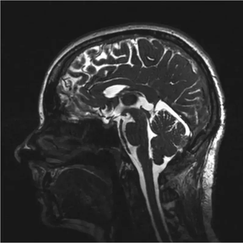 图2：术后MRI