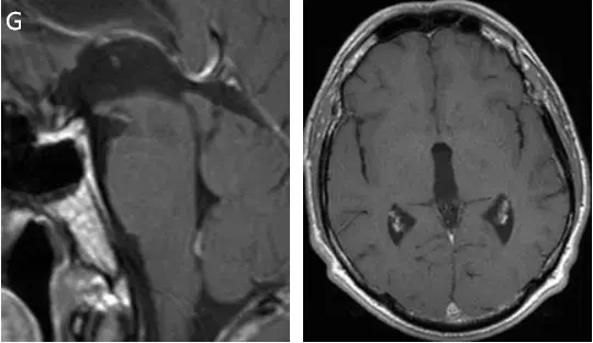 图G，术后MRI，肿瘤全切