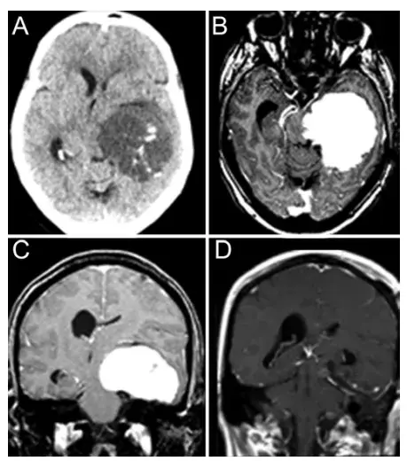 图1.CT（A）显示瘤内出血。MR（B-C）上，该肿块呈现明显强化，并显示出沿小脑幕和左侧中颅窝底的宽基底硬脑膜边缘。全切除（GTR）后MR（D）显示中线移位和占位效应有所改善。