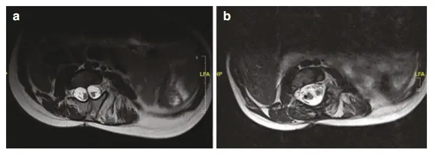 图2 1型SCM的T2加权MRI，显示（a）术前图像，可见骨性骨隔；（b）术后1型SCM，显示骨性骨隔切除后的后方减压。