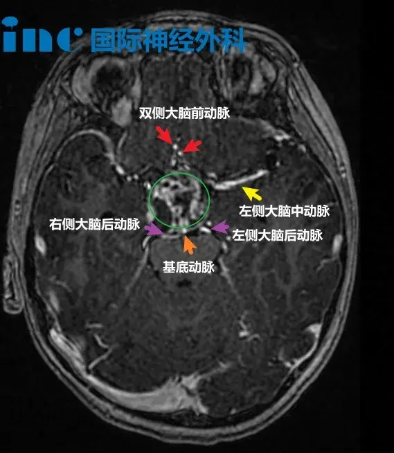 除夕前一天，孩子一个摔倒查出可怕脑瘤！这些方法让我们撑了过来