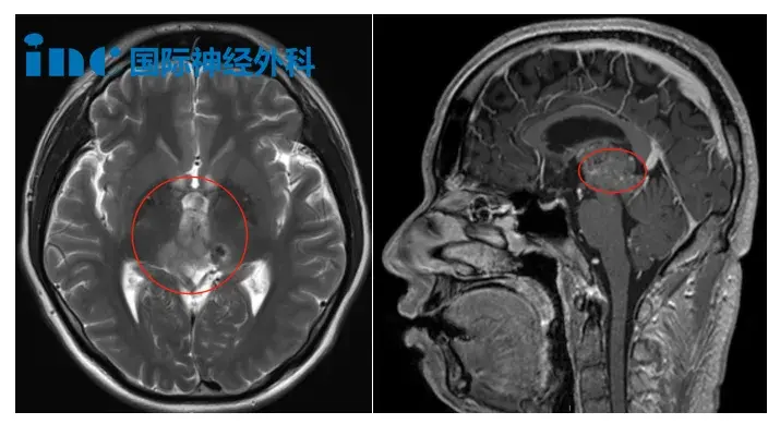 术前MRI