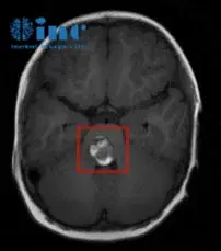 （匆匆的脑干海绵状血管瘤病变位置）