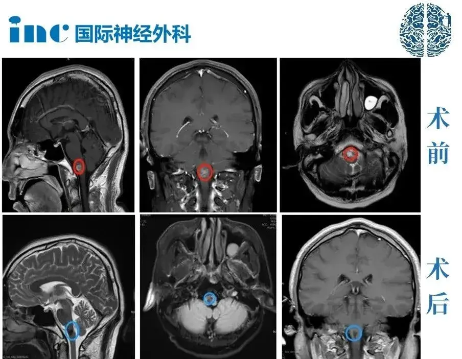 脑干海绵状血管瘤导致的脑干出血