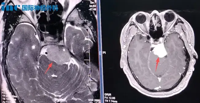 术前MRI