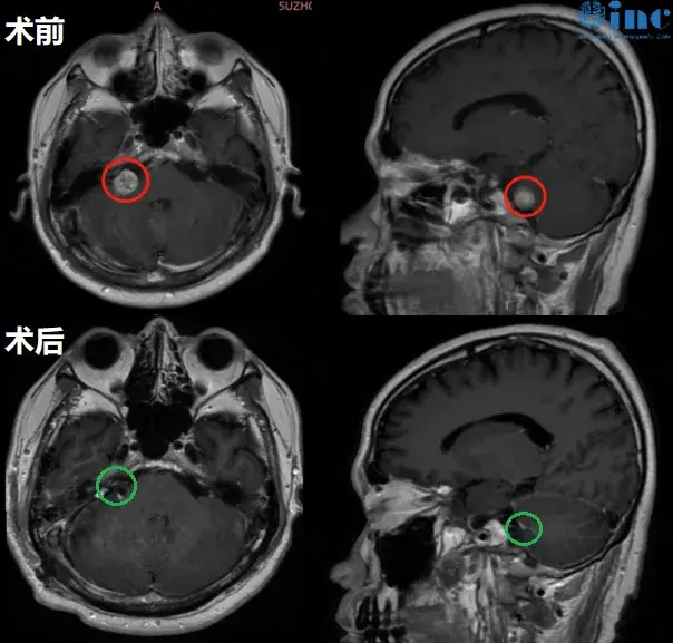 听神经瘤影像