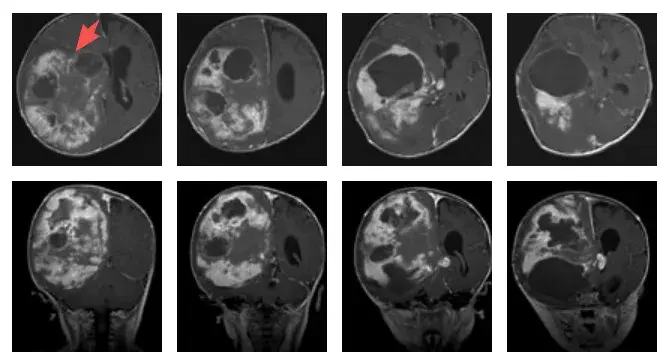 术前MRI