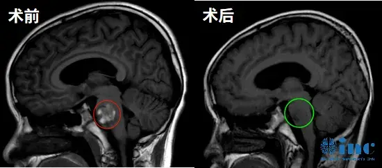 海绵状血管瘤影像
