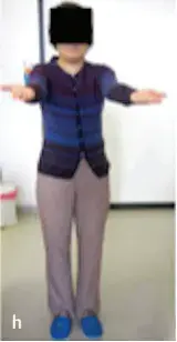 术后11年随访,患者一直无症状