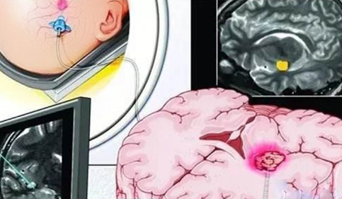 激光间质热疗(LITT)工作原理