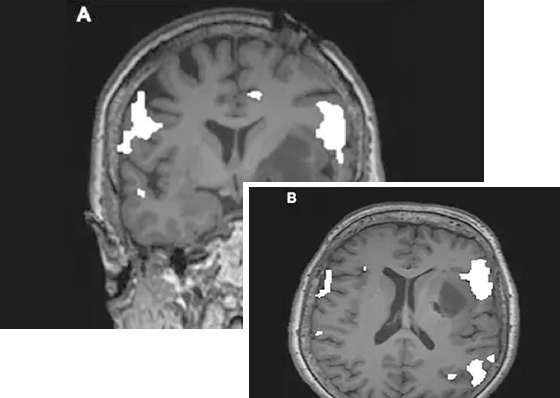 LITT治疗颅内肿瘤的5个优势